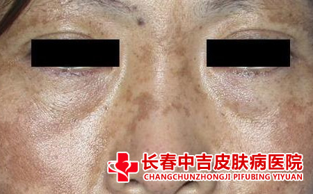 黄褐斑的病因,孕妇黄褐斑
