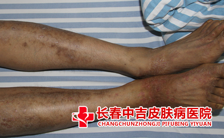 皮炎对患者的危害有什么
