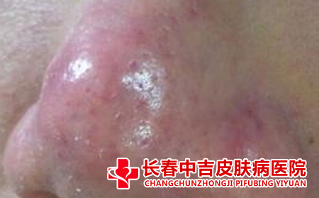酒糟鼻的病因是什么
