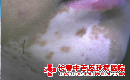 白癜风患者的饮食宜忌