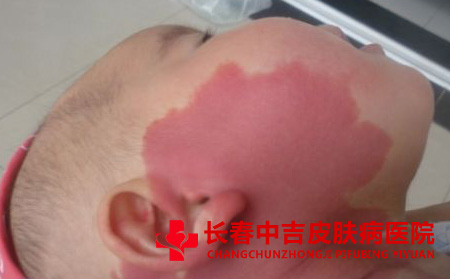 孩子脸上有红色胎记怎么办