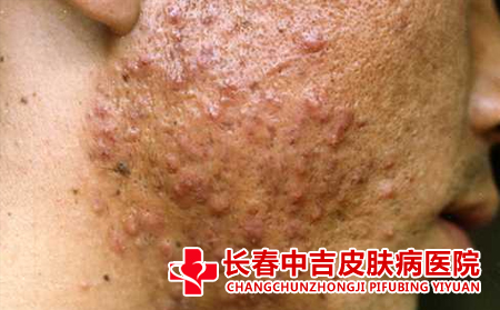 痤疮患者的日常护理