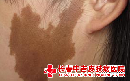 咖啡斑的特点