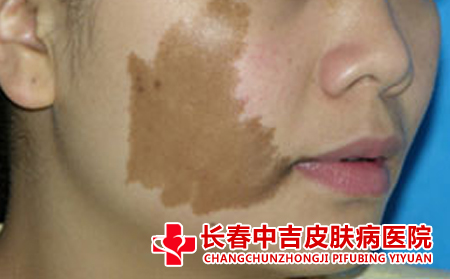 长春哪家医院治疗咖啡斑比较便宜