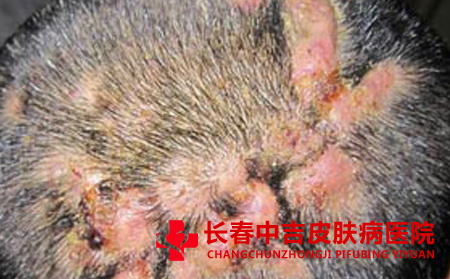 头皮上的毛囊炎用什么方法治不错