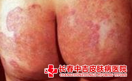 股癣的病因,常见的股癣的病因是什么