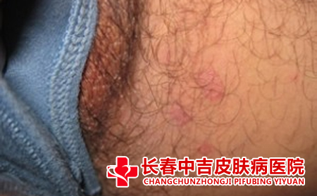 股癣如何护理,怎么护理股癣