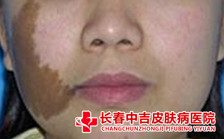 长春市治疗胎记的医院哪家合适