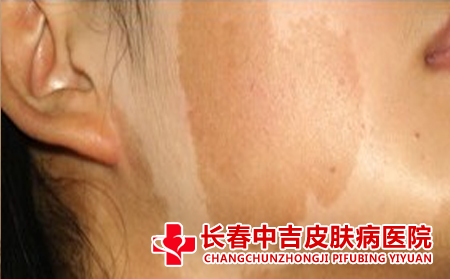 如何照顾胎记患者
