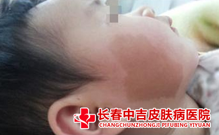 胎记对患者的危害表现在哪些方面