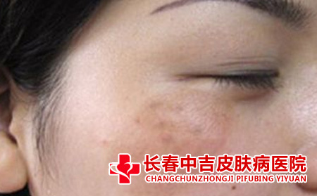 长春治疗黄褐斑,黄褐斑的治疗医院