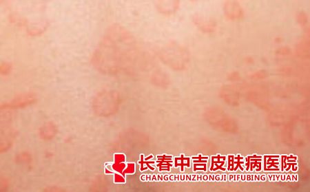 皮炎有什么症状