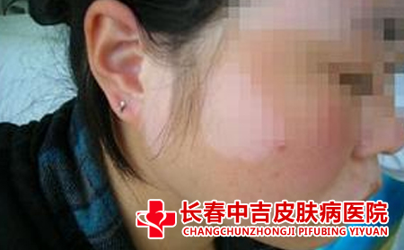饮食上白癜风患者应该怎么做