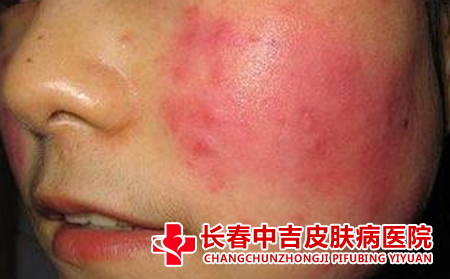 脸上有红血丝吃什么食物合适