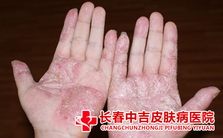 癣,治疗,长春治疗癣的医院
