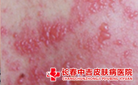 带状疱疹症状表现有哪些