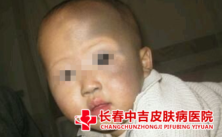 胎记的治疗要注意什么