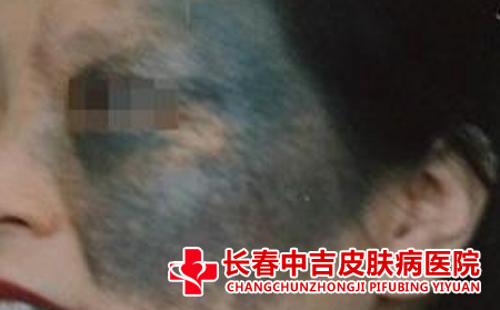 长春治疗胎记的费用多吗