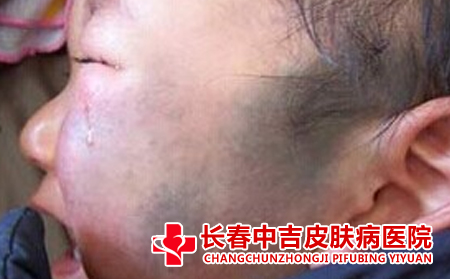 胎记会影响儿童患者的哪些方面