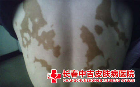 白癜风患者在选择工作的时候要注意什么
