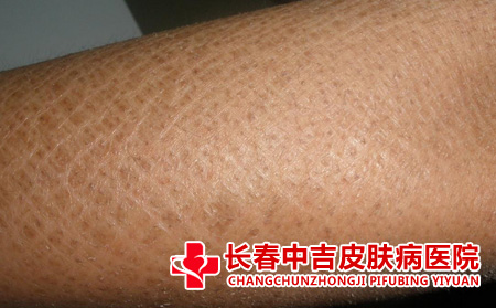 鱼鳞病,鱼鳞病患者病情反复的原因