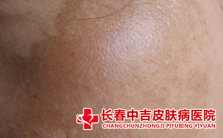 黄褐斑怎么预防,女性如何预防黄褐斑