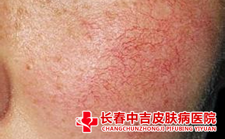 是什么造成了脸上长有红血丝