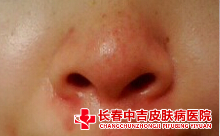酒糟鼻患者应该怎么护理