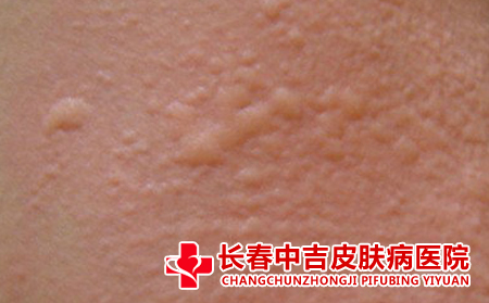 荨麻疹要怎么治疗