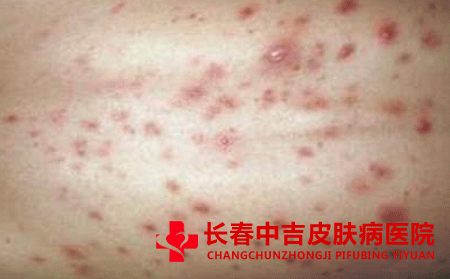 怎样治毛囊炎会比较不错呢