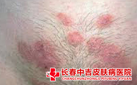 治疗癣的医院,癣,长春治疗癣