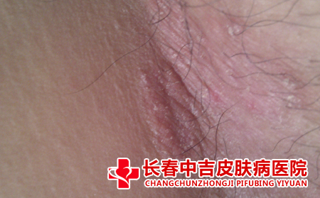 癣的常识是什么,癣