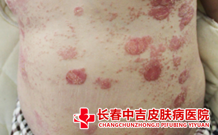 铜钱癣是什么,铜钱癣