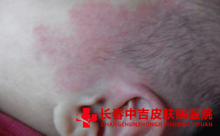 孩子皮肤上长胎记是什么原因造成的