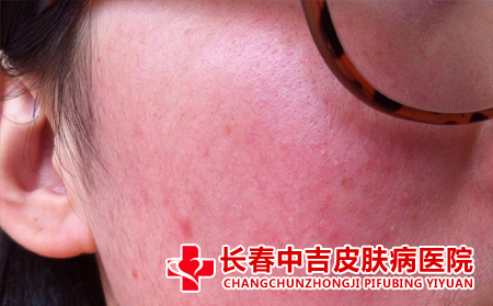 在面部长有红血丝要如何改善