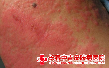 长春治疗湿疹,湿疹的治疗医院,湿疹