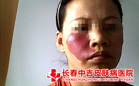 治疗胎记应该去长春的哪家医院