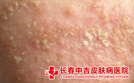 脂溢性皮炎要如何去护理合适