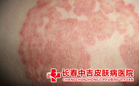 脂溢性皮炎要怎样去处理合适