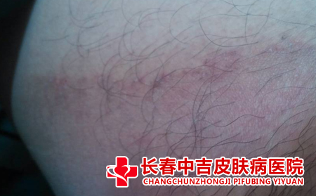 癣怎么诊断,长春诊断癣
