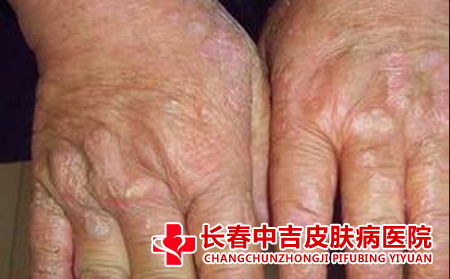 手癣的症状,手癣的判断方法