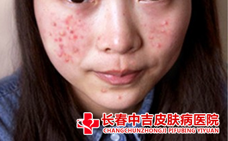 长春治疗痤疮的医院怎么样
