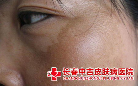 黄褐斑,缓解黄褐斑