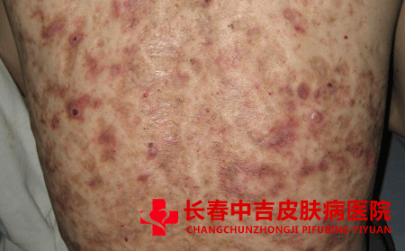 身上有毛囊炎怎样处理