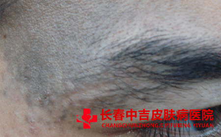 成年人身上胎记该怎么处理