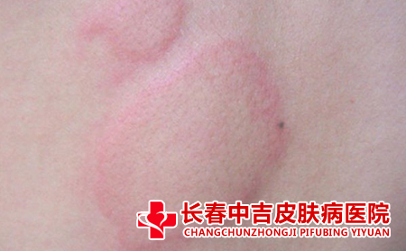 荨麻疹的治疗方式