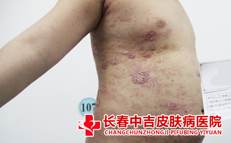 癣,治疗,治疗癣的医院