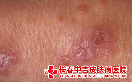 皮炎怎么治疗,如何治疗皮炎