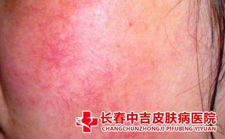 脸上长红血丝要如何去护理