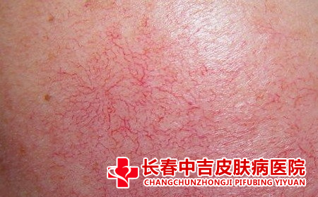 夏季脸上的红血丝怎样缓解合适